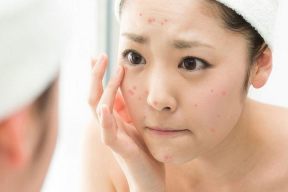 Da loại nào dễ mọc mụn?