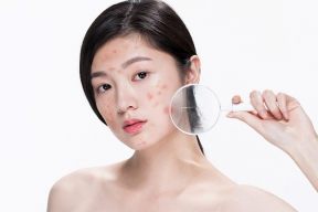 Mụn Viêm Là Gì? Cách Chăm Sóc Mụn Viêm Tại Nhà Đúng Cách