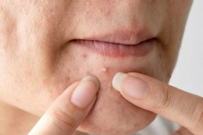 Mụn đầu trắng và những điều cần biết