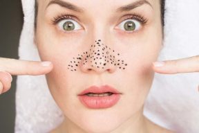 Mách bạn 3 cách trị mụn đầu đen tại nhà cực kỳ hiệu quả