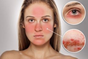 Mách bạn 5 cách làm mặt nạ tự nhiên cho da dầu mụn