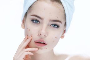 Làm sao để mụn không tấn công sau Tết