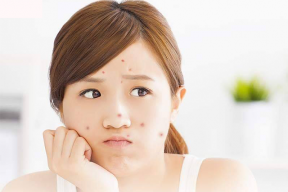Điểm Danh Các Loại Mụn Thường Gặp Mà Bạn Cần Biết