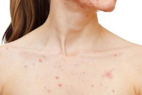 LÀM THẾ NÀO ĐỂ BẠN CÓ THỂ GIẢI QUYẾT MỤN NGỰC MỘT CÁCH HIỆU QUẢ