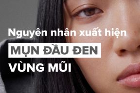 Nguyên nhân nổi mụn đầu đen ở mũi và cách khắc phục hiệu quả