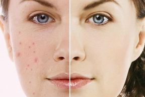 KEM DƯỠNG GIẢM MỤN HIỆU QUẢ CẦN NHỮNG TIÊU CHÍ NÀO?